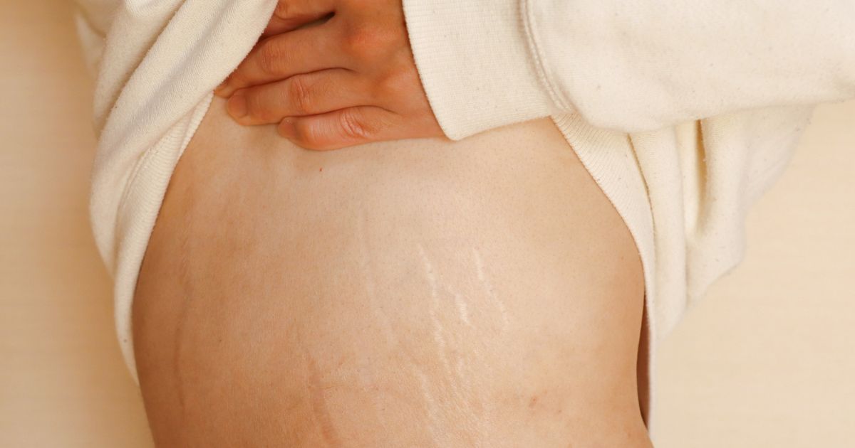 Melhores ingredientes para combater estrias na pele